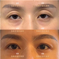 张鹤亭眼睛做的怎么样