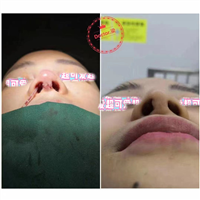 上海肋软骨隆鼻专家梁亮医生
