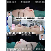 上海鼻整形修复专家