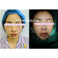 梁亮鼻整形