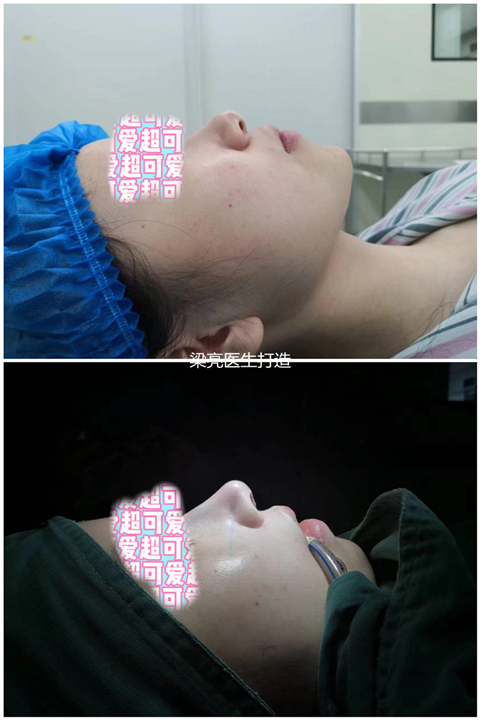 梁亮鼻整形医生
