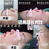 上海鼻整形修复专家梁亮医生