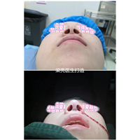 上海肋骨鼻修复医生