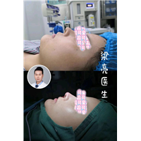 梁亮鼻整形案例