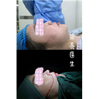 上海梁亮医生肋骨鼻整形