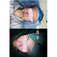 上海肋骨鼻整形专家梁亮医生