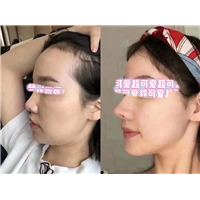 梁亮鼻整形