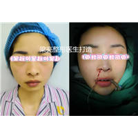 上海梁亮医生鼻整形案例