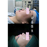 梁亮鼻综合案例