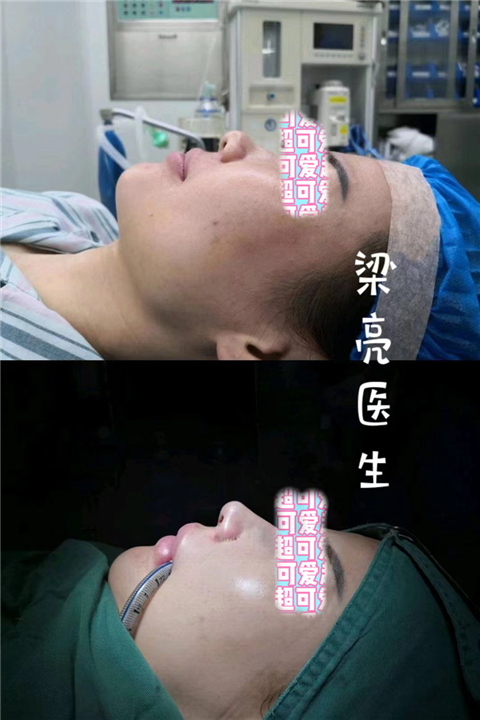 梁亮鼻整形医生