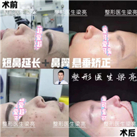 上海鼻部整形专家梁亮医生