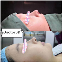 上海肋骨鼻修复医生