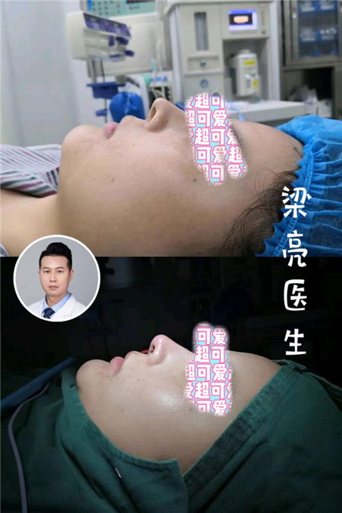 梁亮医生鼻综合案例
