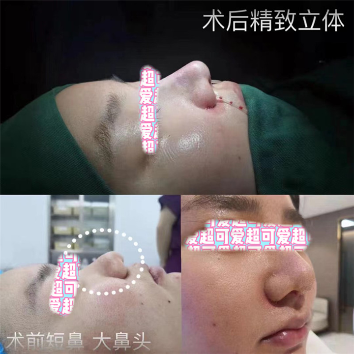 上海肋骨鼻整形专家