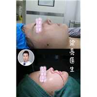 梁亮鼻综合案例