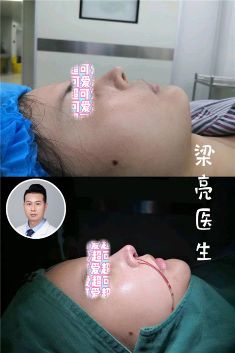 上海梁亮医生做鼻子怎么样