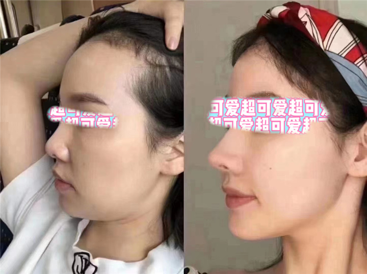 上海梁亮医生做鼻子怎么样