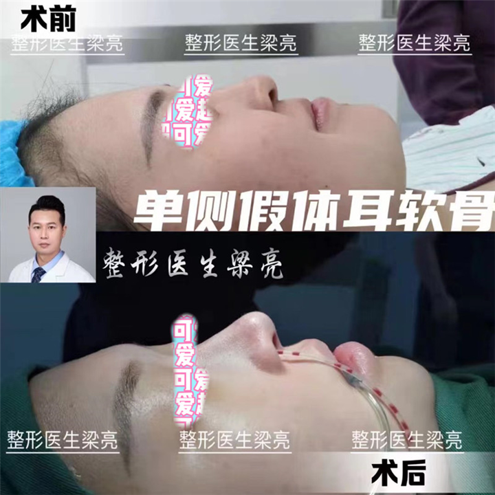 上海肋骨鼻整形专家梁亮医生