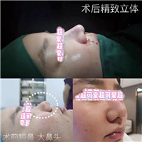 上海肋骨鼻整形专家