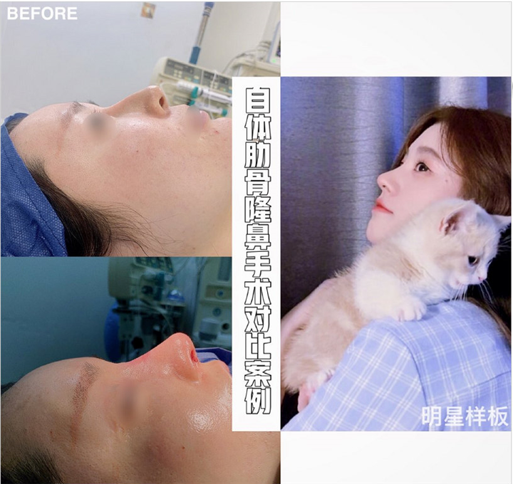 上海做肋骨鼻@做肋骨鼻的好处 
