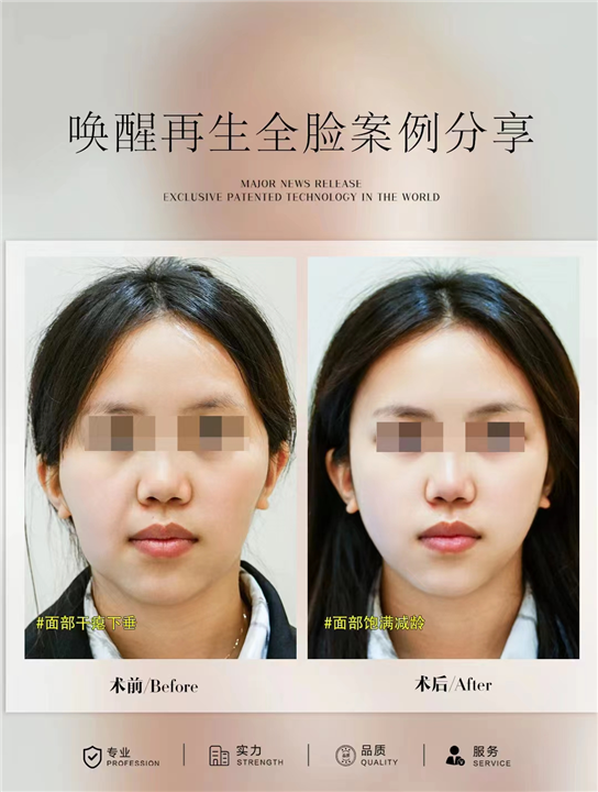 唤醒再生术全脸案例