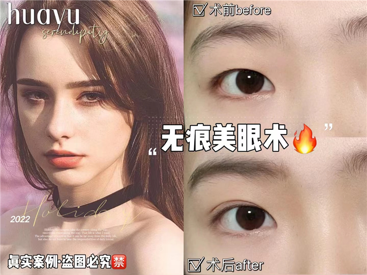 剥离无痕美眼术