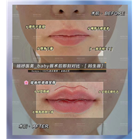唇部再生激活案例