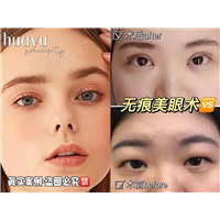 剥离无痕美眼术