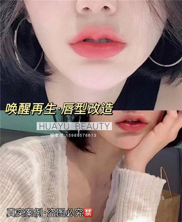 再生细胞剥离术唇