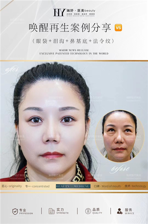 唤醒再生术全脸案例