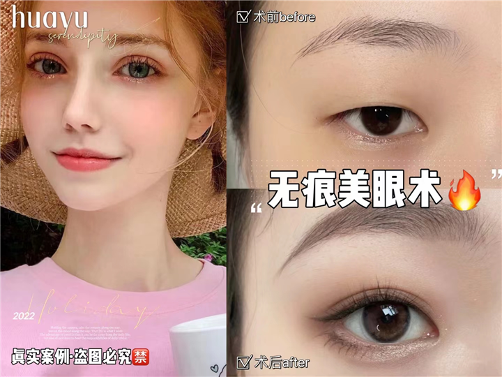 剥离无痕美眼术
