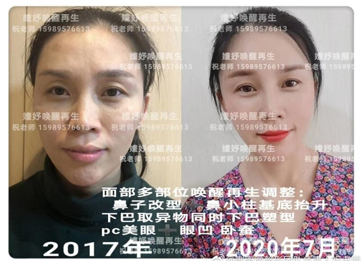 深圳剥离术哪家好