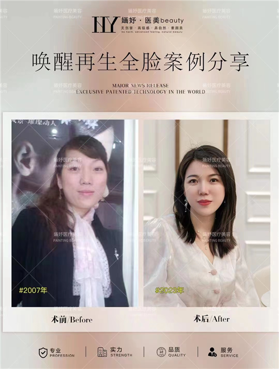 唤醒再生术全脸案例