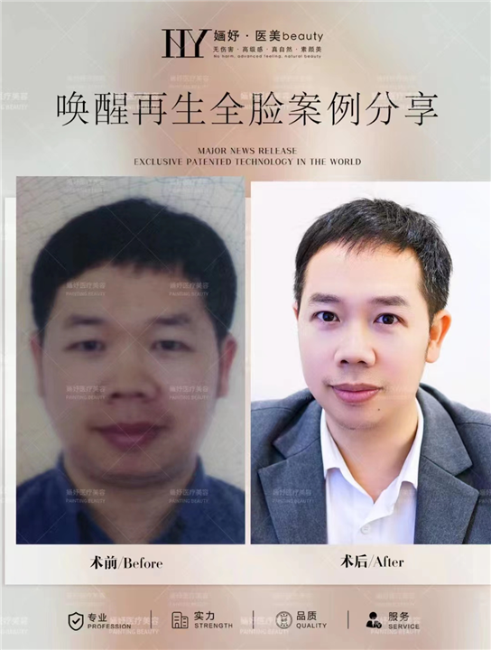 深圳唤醒再生术