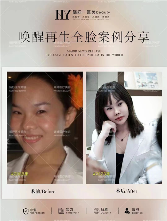 唤醒再生术全脸案例