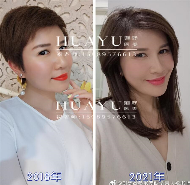 剥离再生术健康轻医美