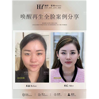 唤醒再生术全脸案例
