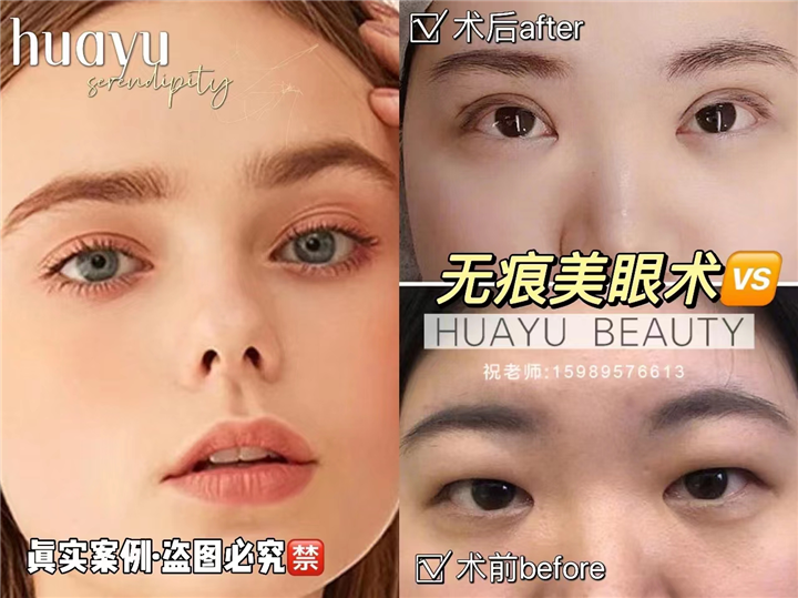 剥离再生术健康轻医美