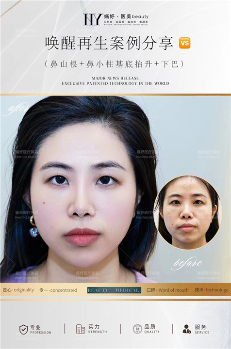 唤醒再生术全脸案例