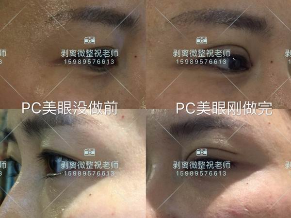 剥离微雕杨医生|剥离微整的费用