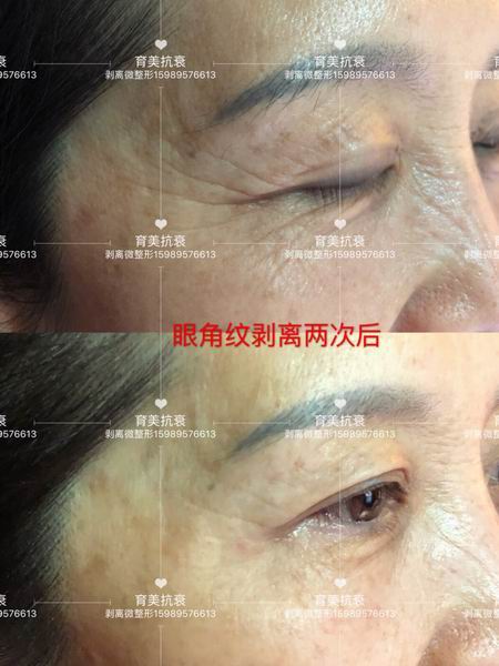 剥离微整的费用|印第安纹三维剥离