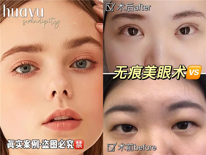 剥离无痕美眼术