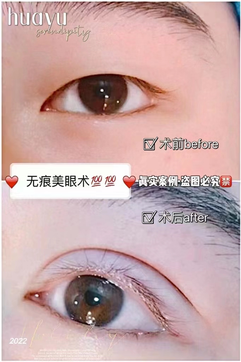 剥离无痕美眼术