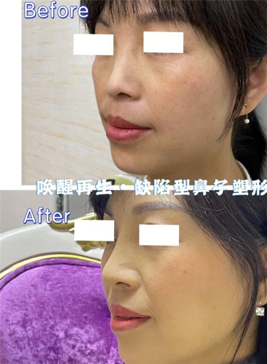 剥离轻医美
