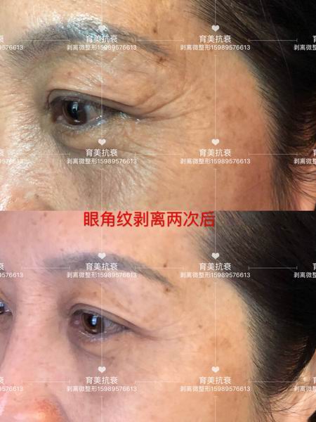 剥离微雕杨医生|剥离微整的费用