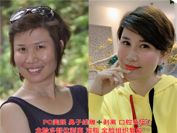 剥离微整是什么?