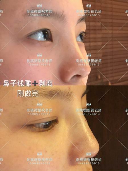 剥离微整安全吗|全脸剥离微雕