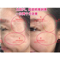 深圳剥离微雕|剥离太阳穴价格