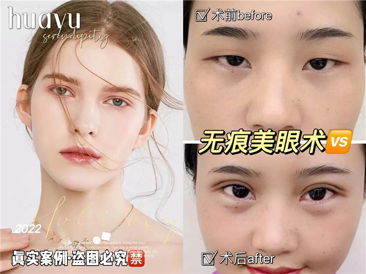 剥离再生术健康轻医美