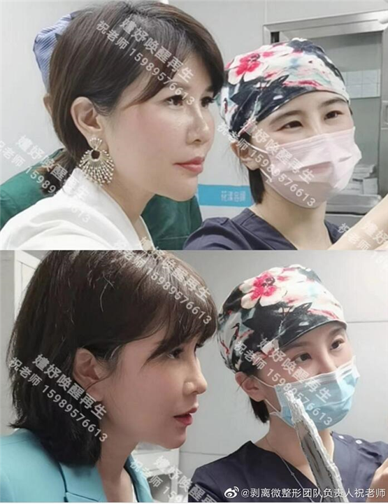 剥离微整费用